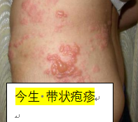 带你了解带状疱疹的前世今生(图2)