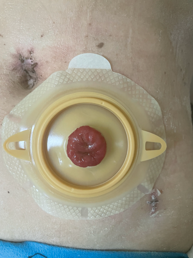 5,必要时使用防漏膏后依造口位置由下而上将底盘贴上4,测量造口大小并