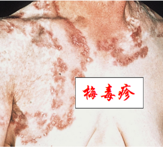 不要梅毒,要没毒(图5)