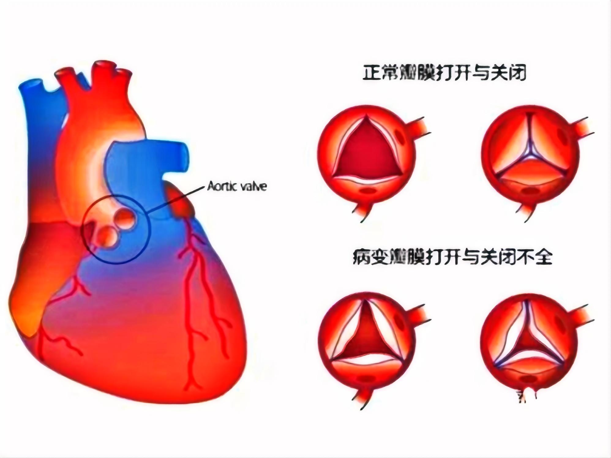 关注心衰,守护心脏(图4) 关注心衰,守护心脏(图4)
