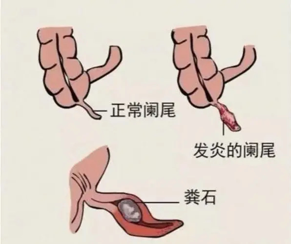 阑尾炎你还在一切了之吗?ERAT——不开刀治疗阑尾炎的新方法(图1)