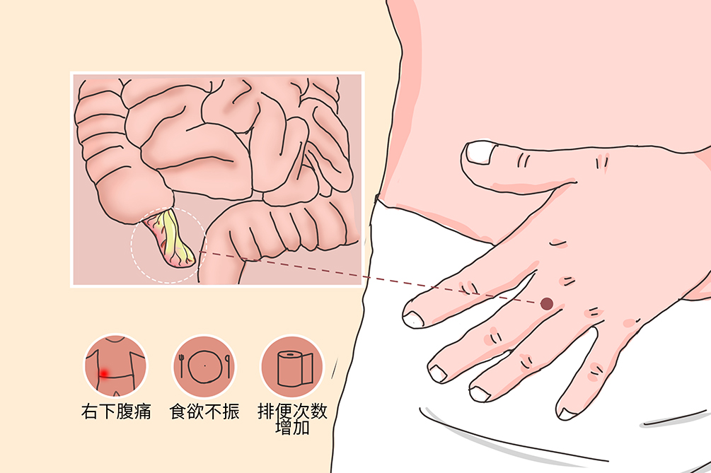 阑尾炎你还在一切了之吗?ERAT——不开刀治疗阑尾炎的新方法(图4)