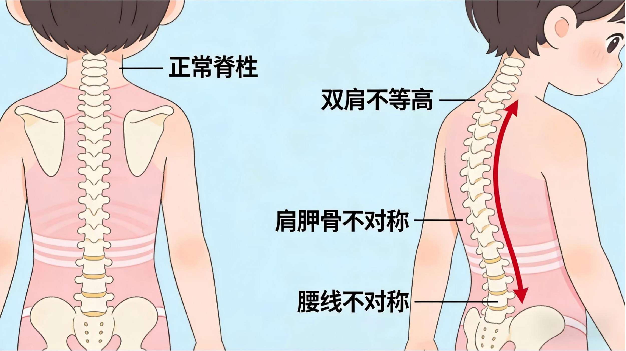 脊柱的“悄悄话”：别让孩子的成长被“压弯了腰”(图2)