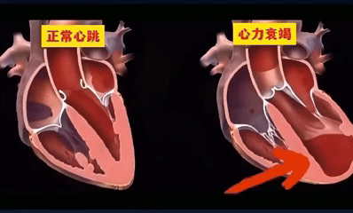 称重控水做得好,心衰少往医院跑(图2) 1-260514111PR18.gif